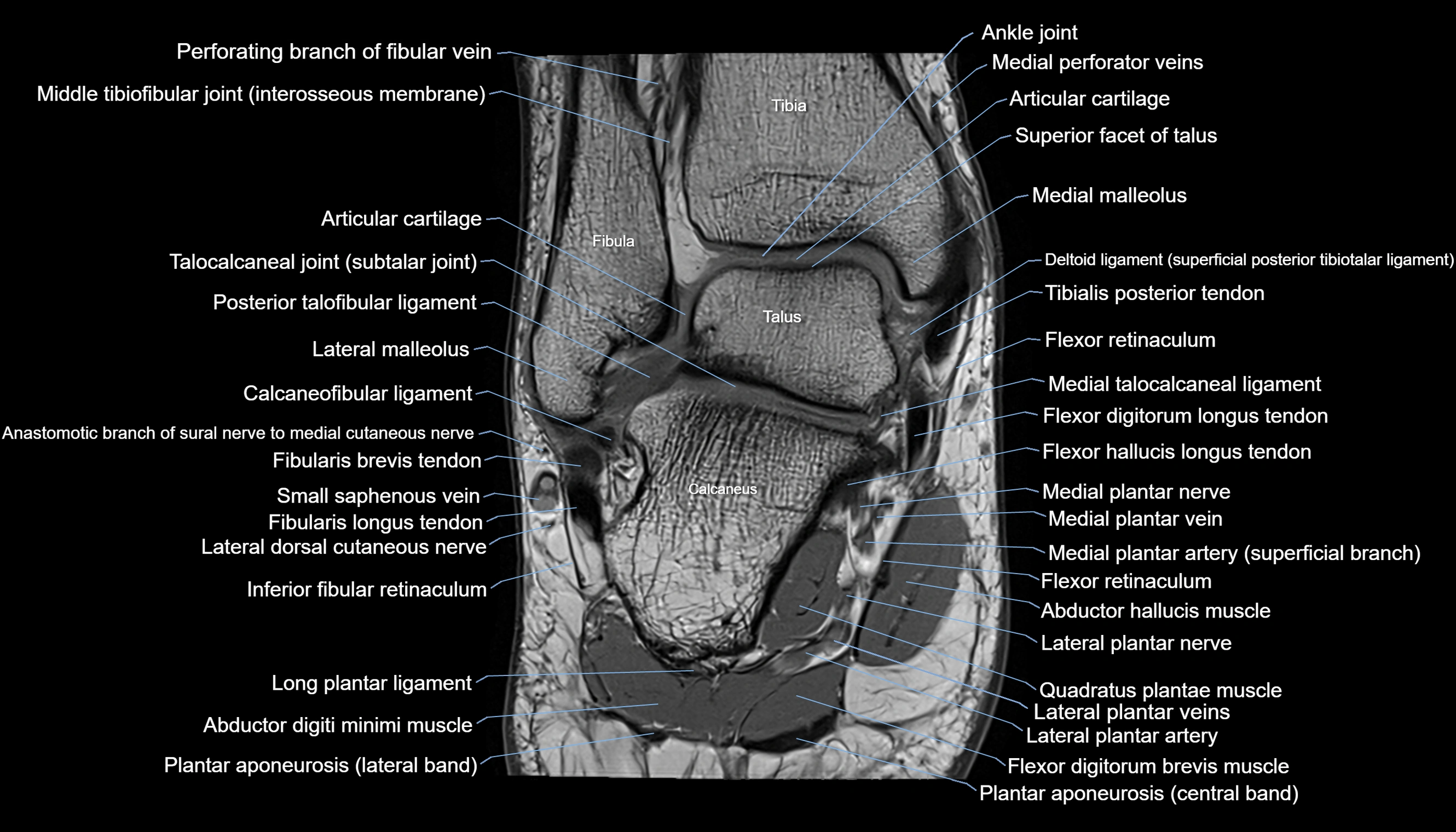 Ankle coronal anatomy 3T MRI images -img-11001-00015.webp